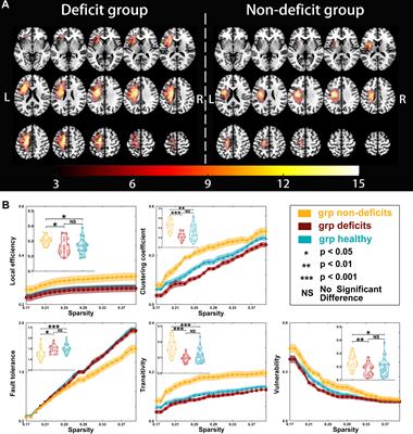 Contralesional Sensorimotor Network Participates in Motor Functional Compensation in Glioma Patients